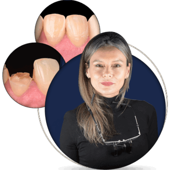 Restoring Broken Front Teeth: Mastering Class IV Direct Composite Restorations
