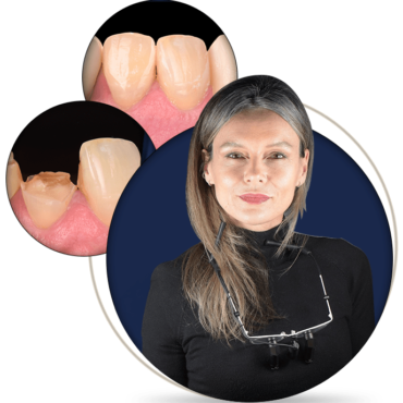Restoring Broken Front Teeth: Mastering Class IV Direct Composite Restorations