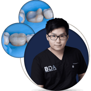 Adhesive Cementation of Posterior Restorations: The Complete Guide