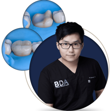 Adhesive Cementation of Posterior Restorations: The Complete Guide