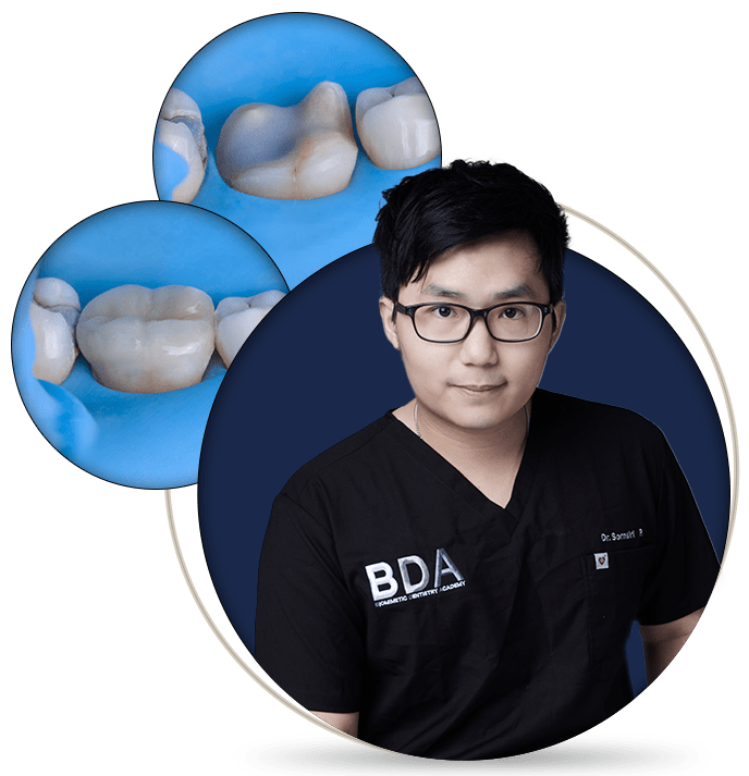 Adhesive Cementation of Posterior Restorations: The Complete Guide