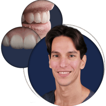 Direct Composite Veneers: Aesthetic Rehabilitation at Its Best