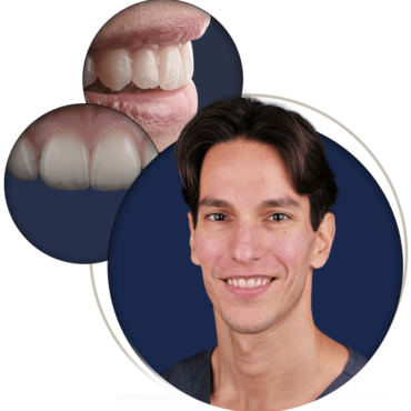 Direct Composite Veneers: Aesthetic Rehabilitation at Its Best