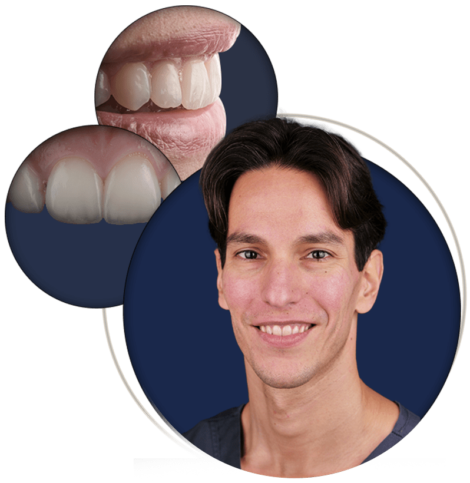 Direct Composite Veneers: Aesthetic Rehabilitation at Its Best