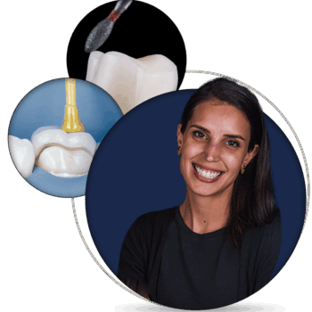 Posterior Adhesive Restorations: The Biomimetic Approach