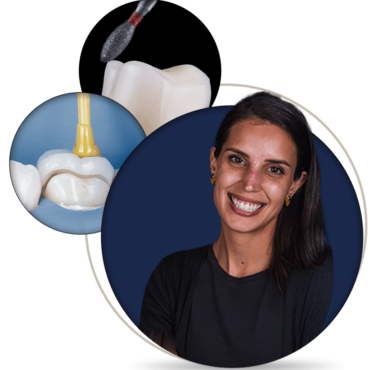 Posterior Adhesive Restorations: The Biomimetic Approach