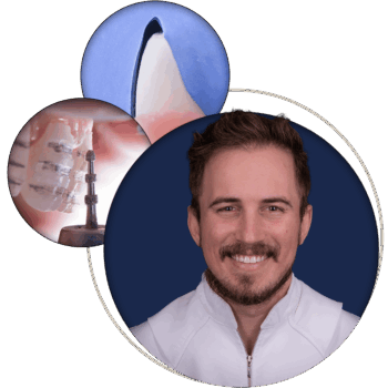 Tooth Preparation for Veneers – Beyond the Basics