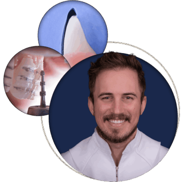 Tooth Preparation for Veneers – Beyond the Basics