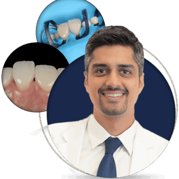 Veneers Cementation: The Delivery Day