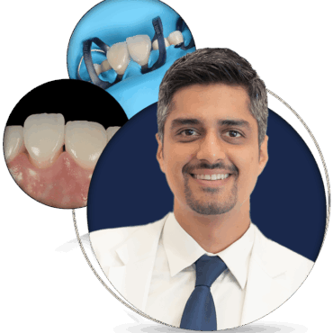 Veneers Cementation: The Delivery Day